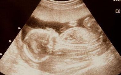 冷冻胚胎的着床时间晚孕酮值是不是会偏低？