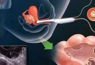 你知道卵泡少用什么试管婴儿方案吗？